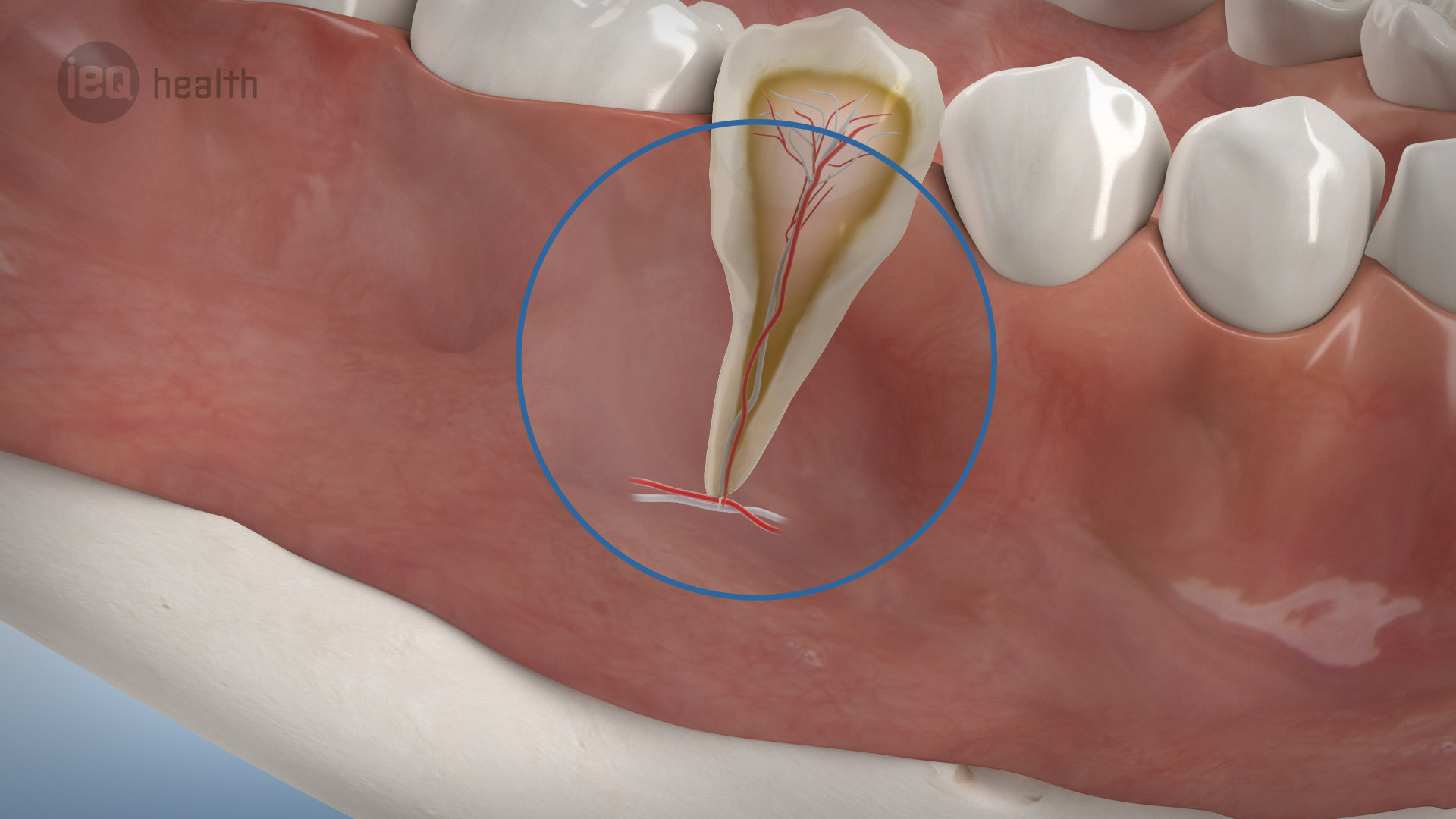 Wurzelspitzenresektion