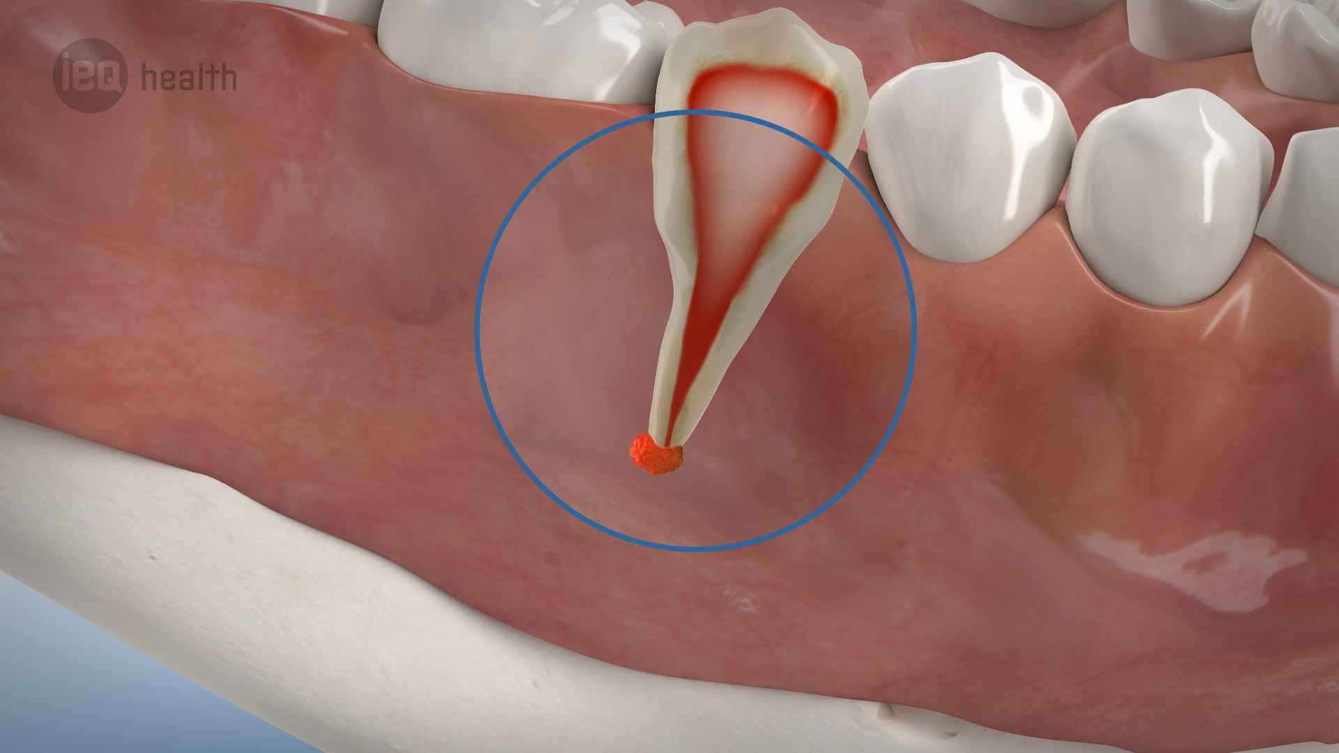 Wurzelspitzenresektion