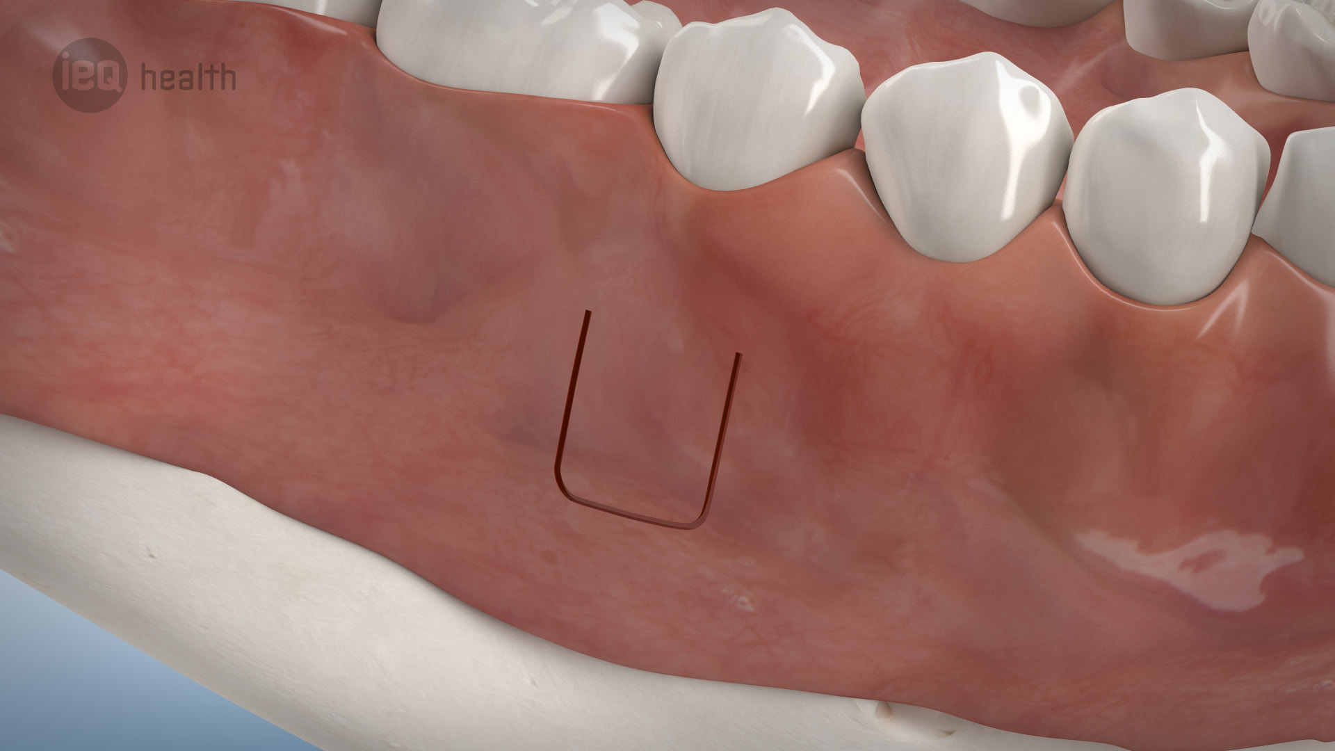 Wurzelspitzenresektion