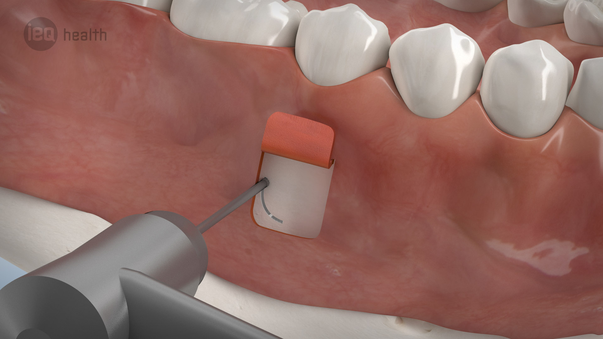 Wurzelspitzenresektion