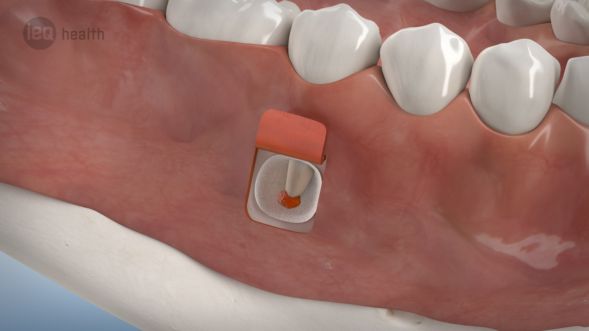 Wurzelspitzenresektion