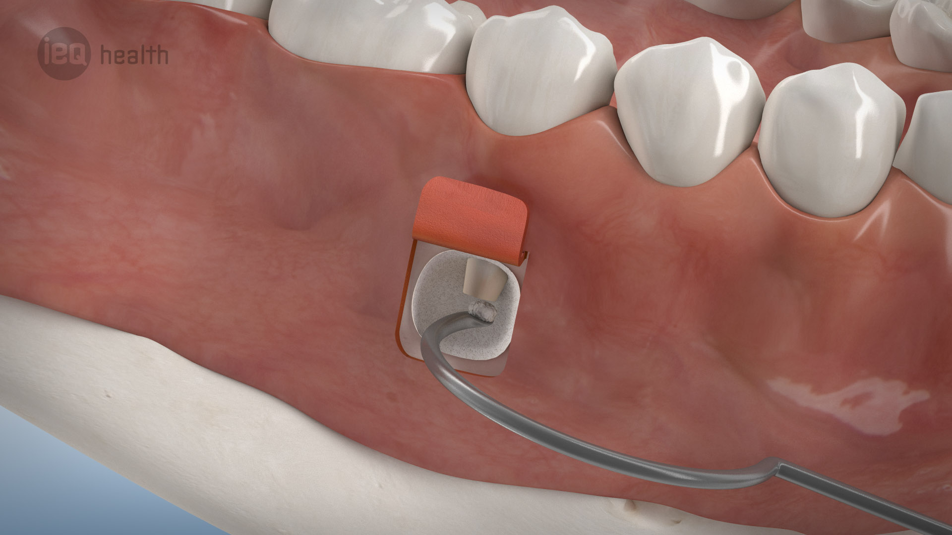 Wurzelspitzenresektion