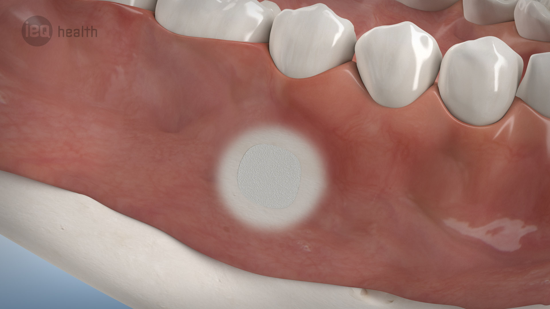 Wurzelspitzenresektion