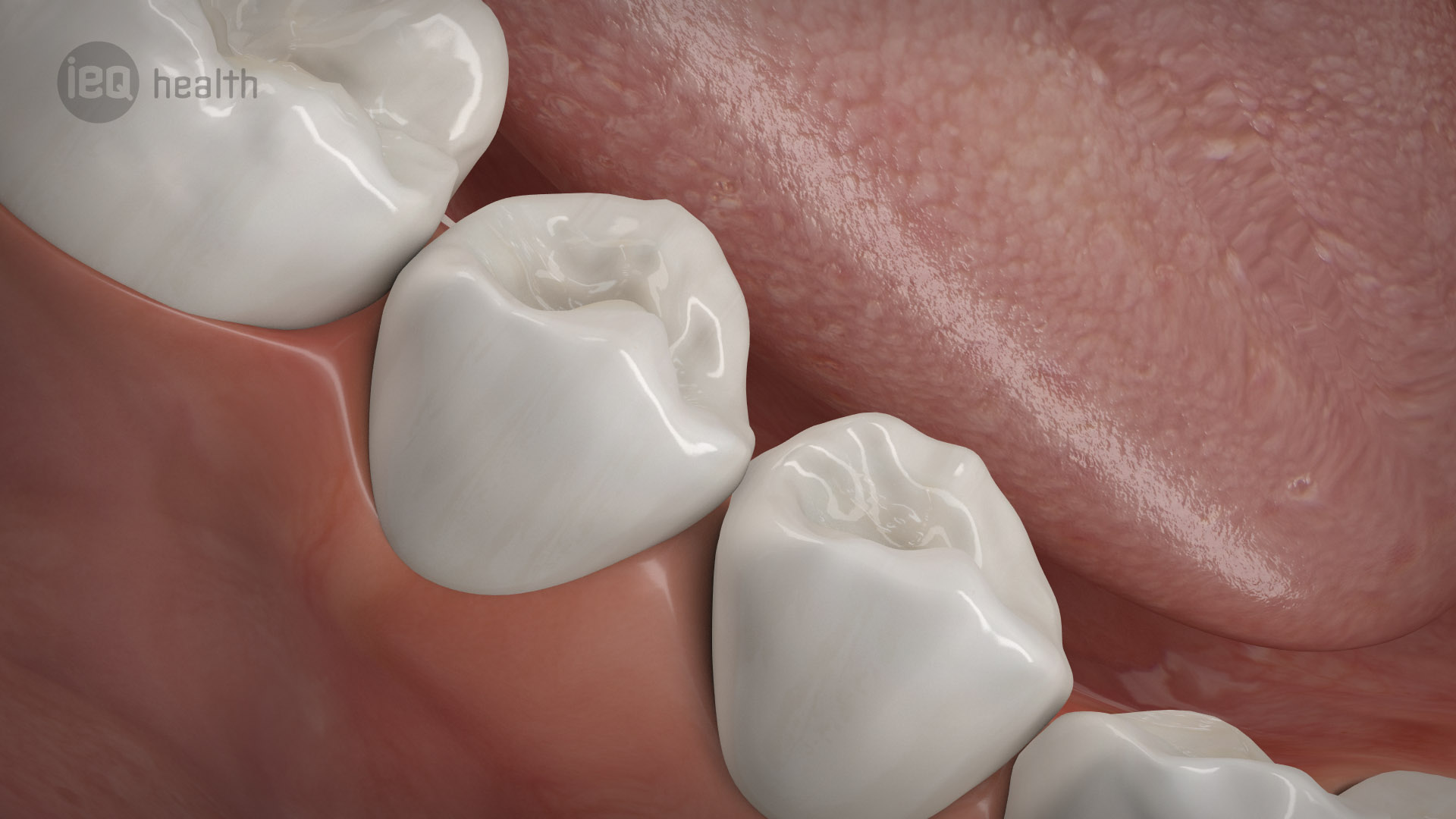 Knochenaufbau Zahnverlust