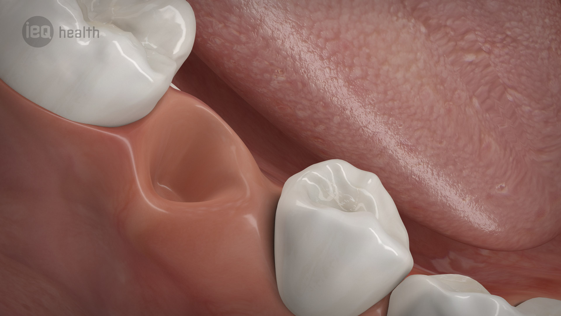 Knochenaufbau Zahnverlust