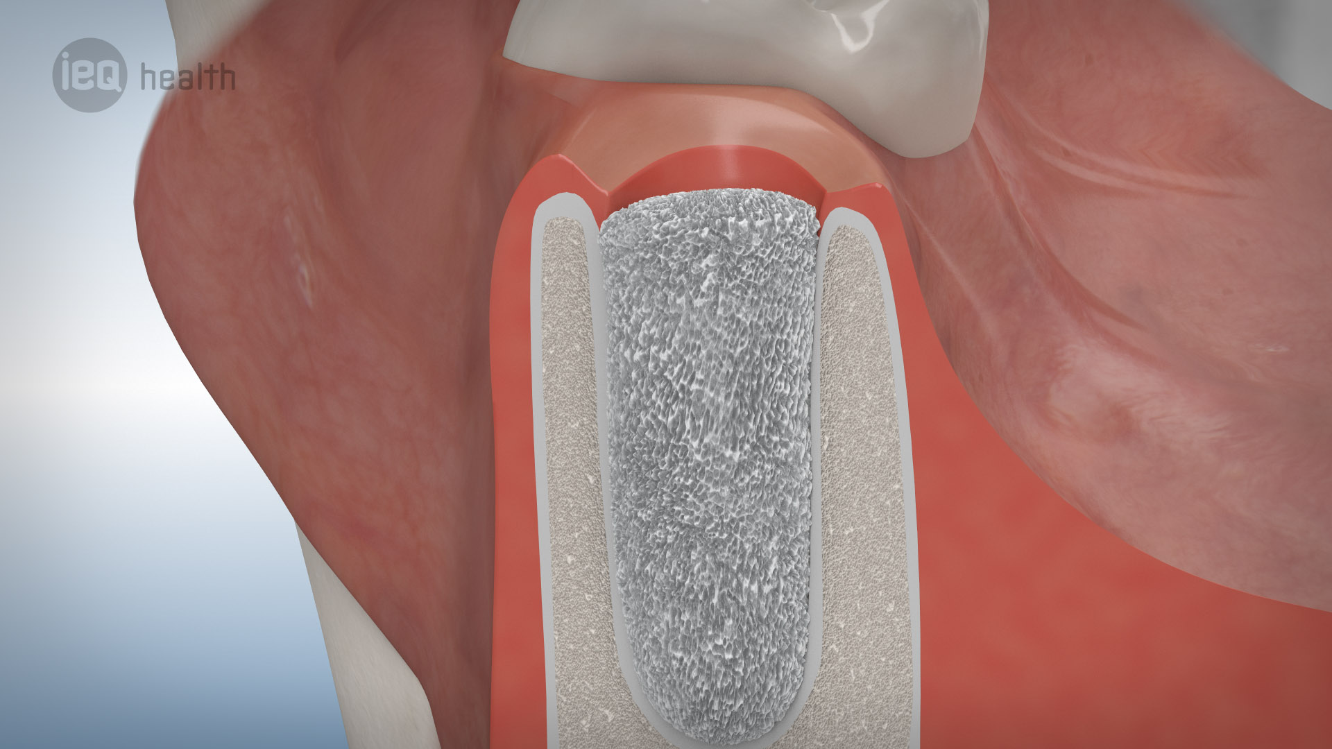 Knochenaufbau Zahnverlust