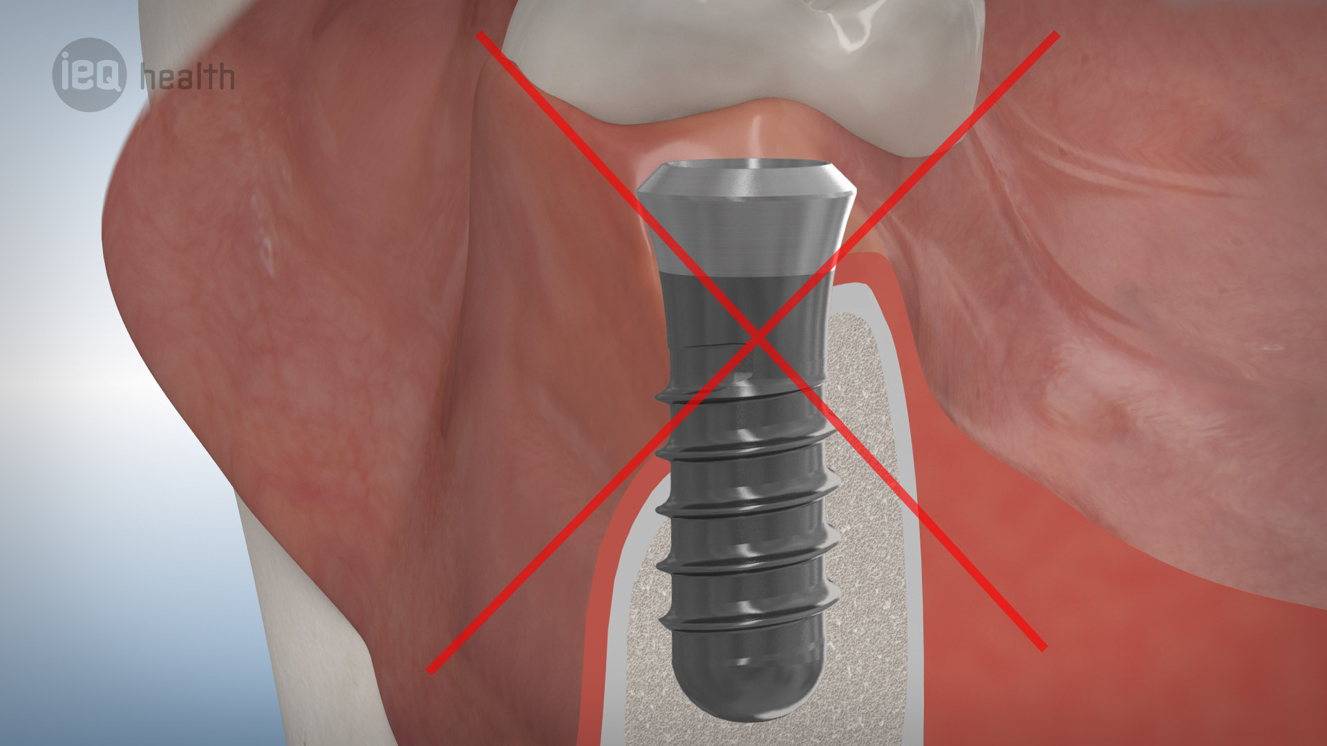 Knochenaufbau Rückbildung