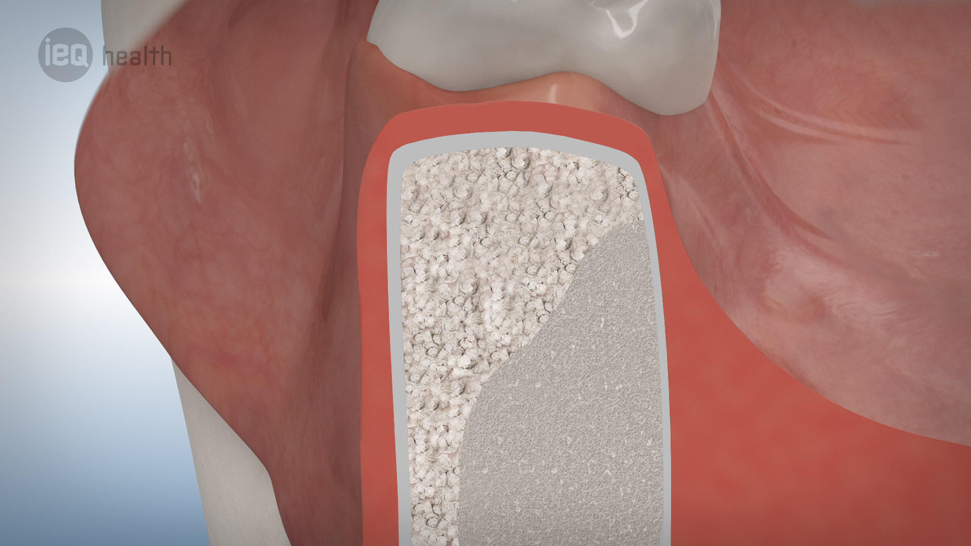 Knochenaufbau Rückbildung