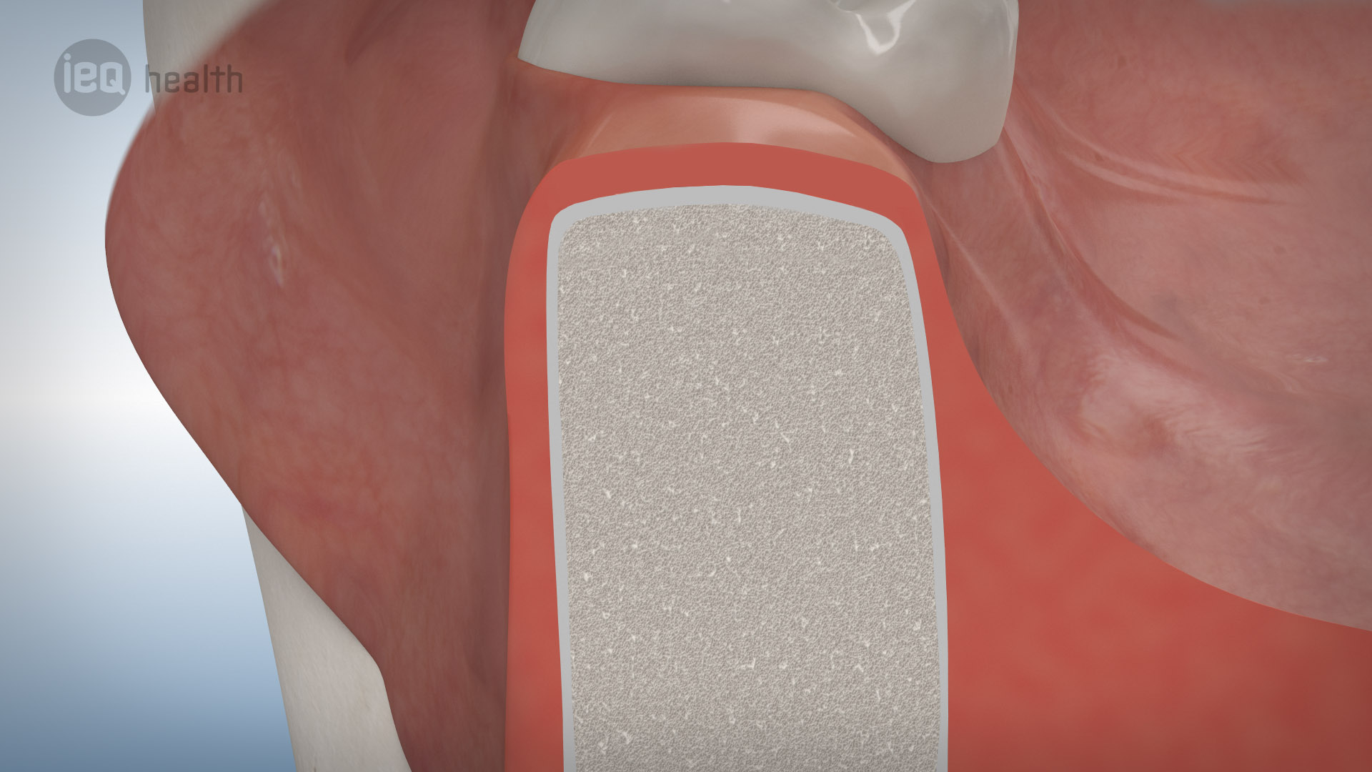 Knochenaufbau Rückbildung