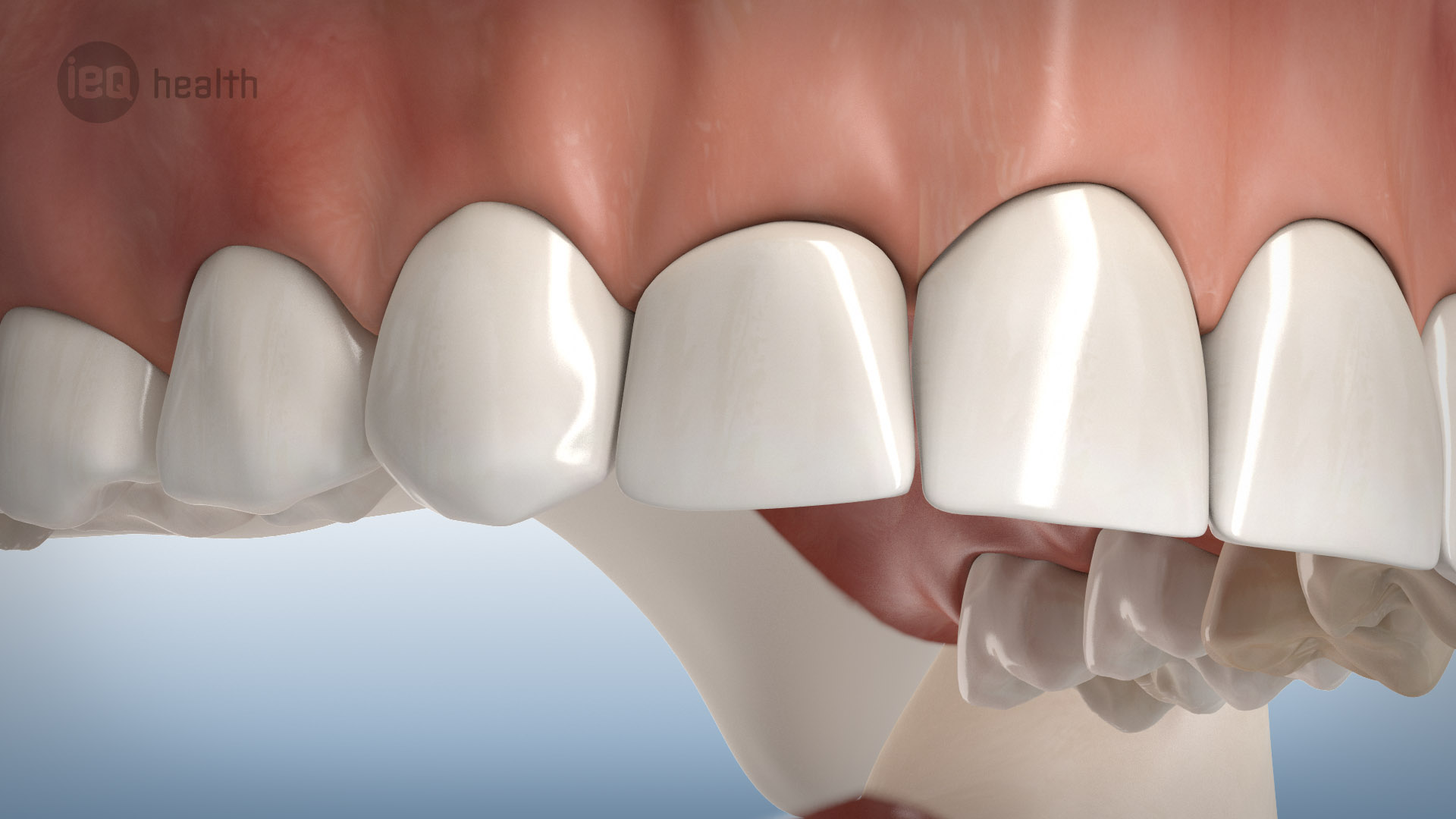 Knochenaufbau um Implantate
