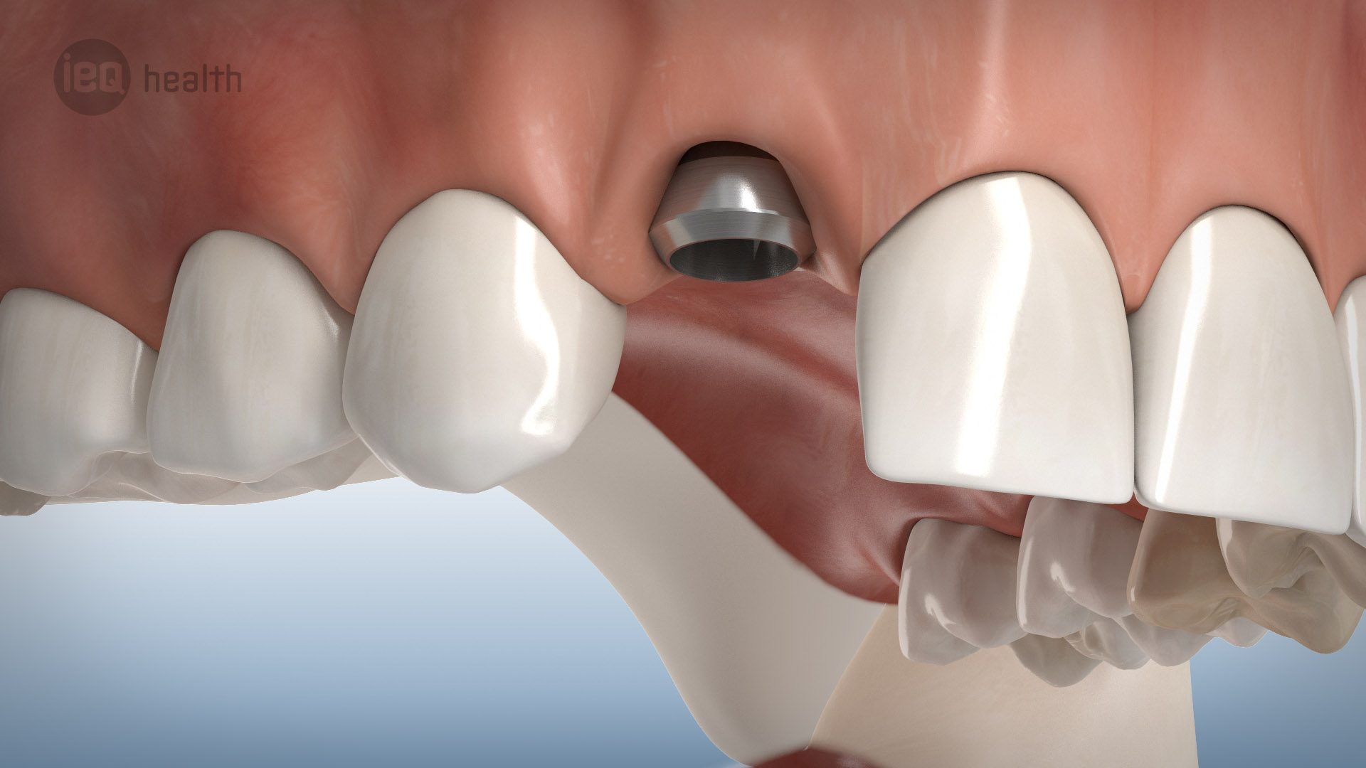 Knochenaufbau um Implantate