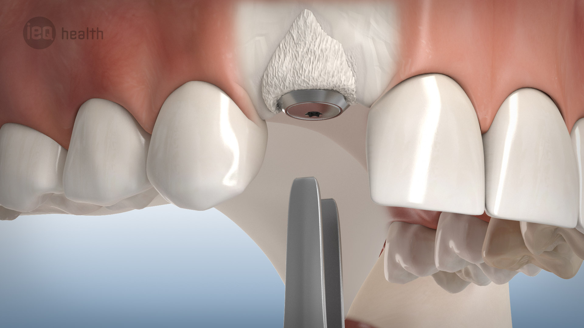 Knochenaufbau um Implantate