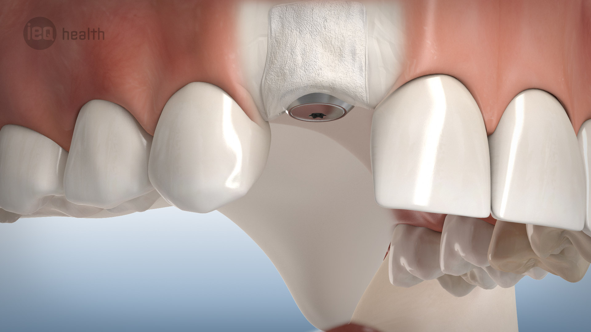 Knochenaufbau um Implantate