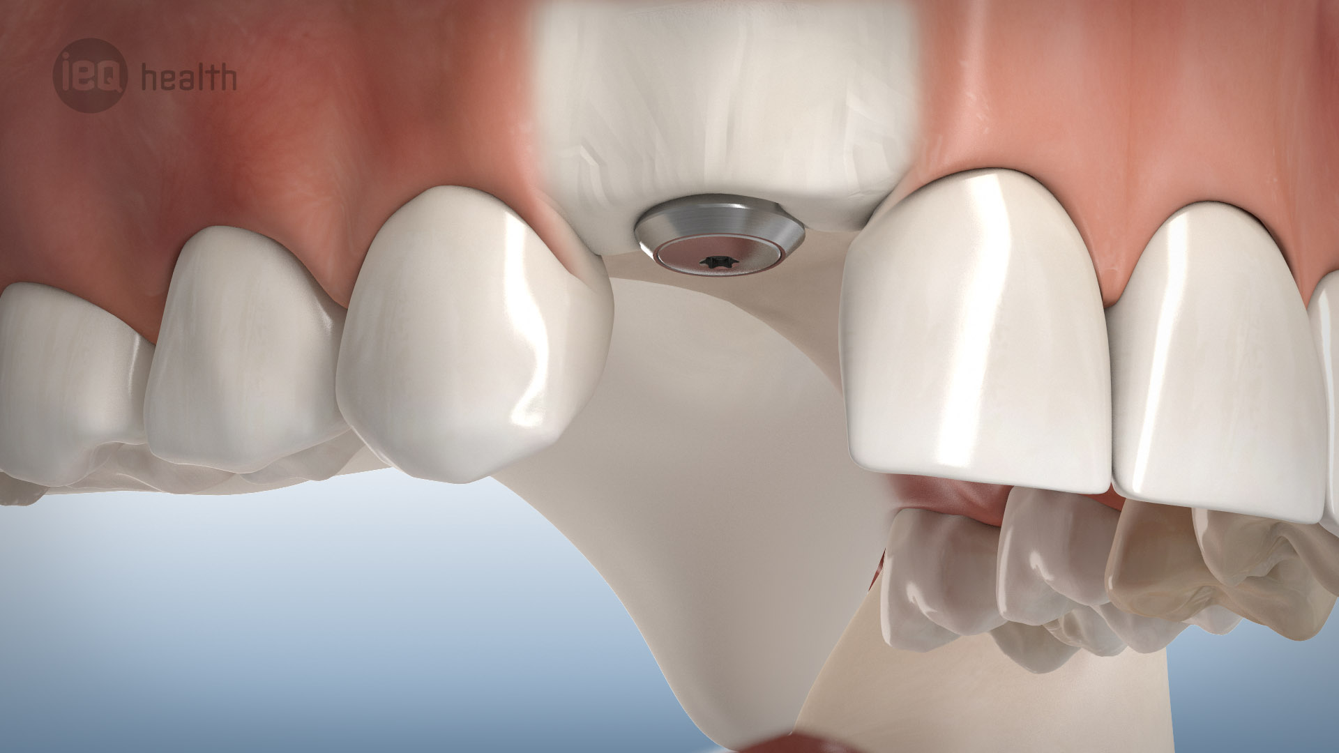 Knochenaufbau um Implantate