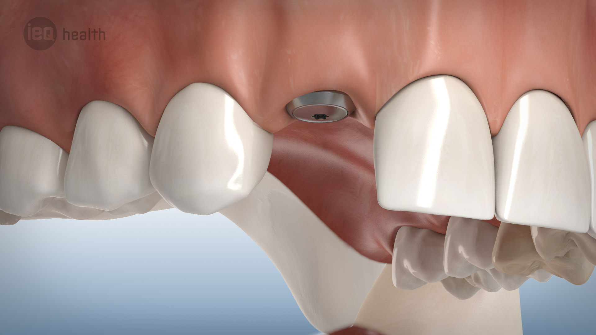Knochenaufbau um Implantate