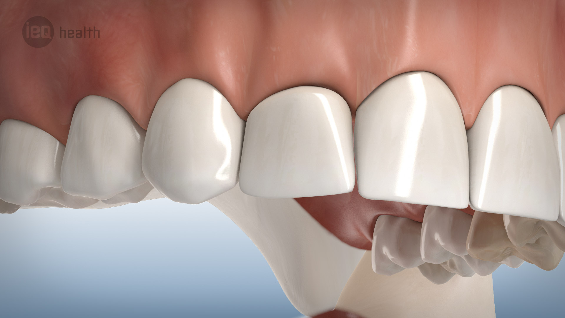 Knochenaufbau um Implantate