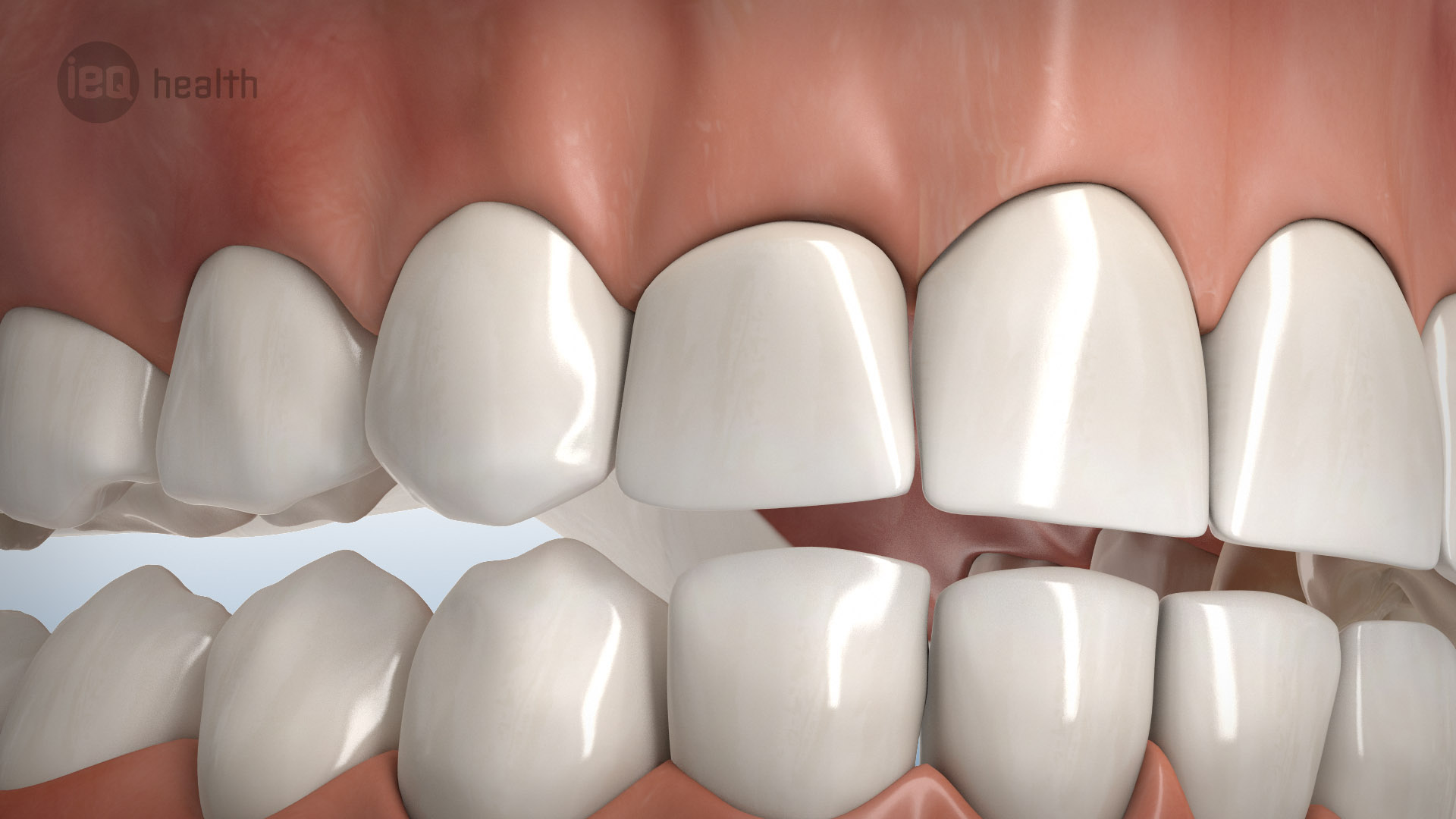 Knochenaufbau um Implantate