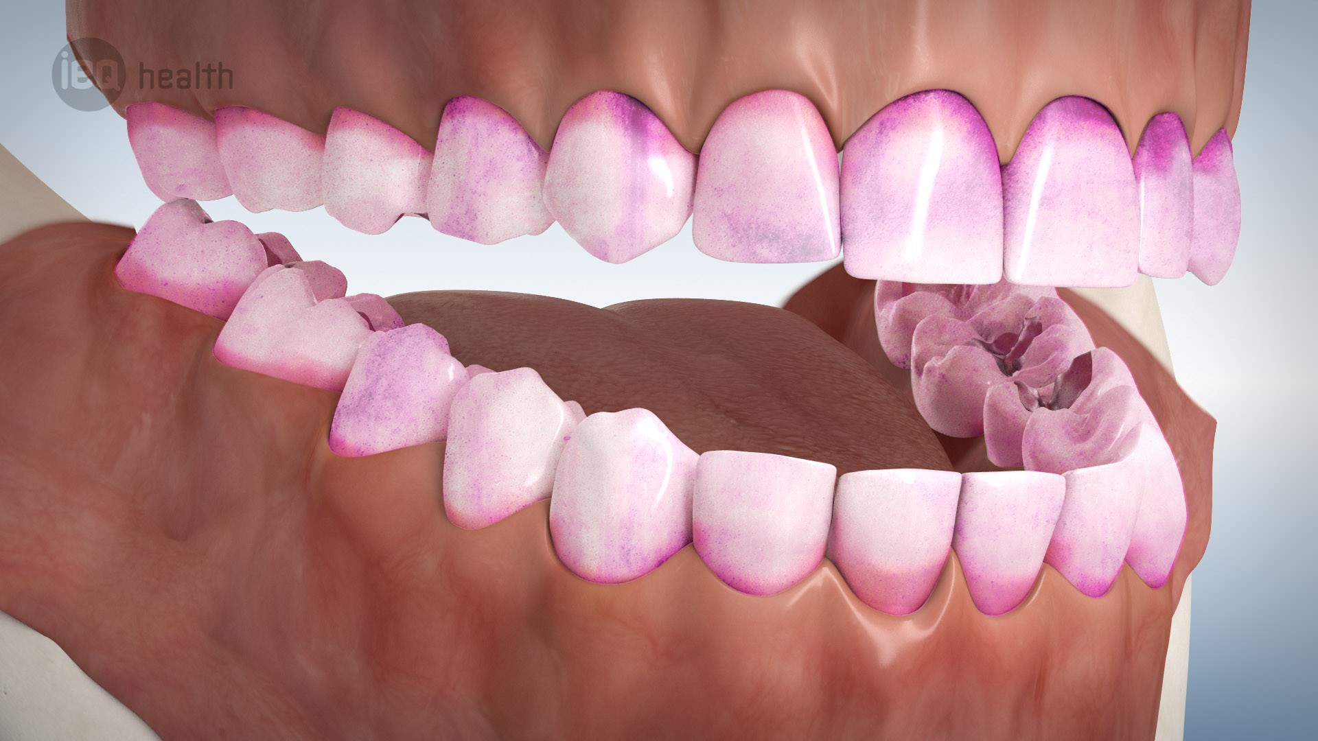 Professionelle Zahnreinigung