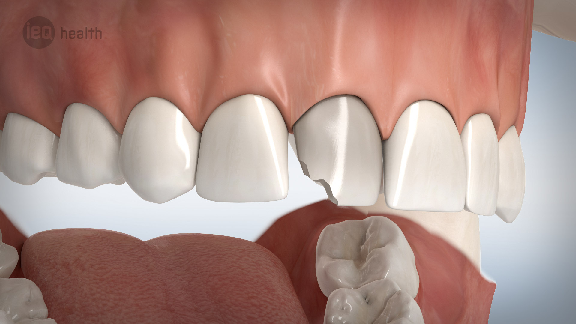 Veneers 02