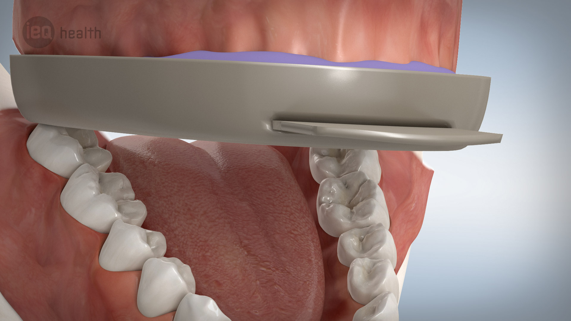 Veneers 05