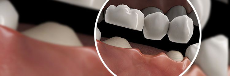 Alternativen zum Zahnimplantat
