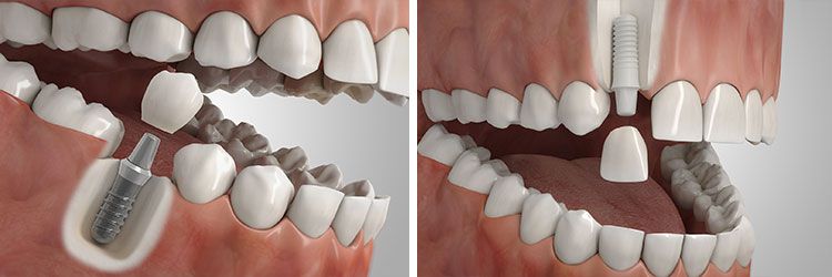 Fehlender Einzelzahn